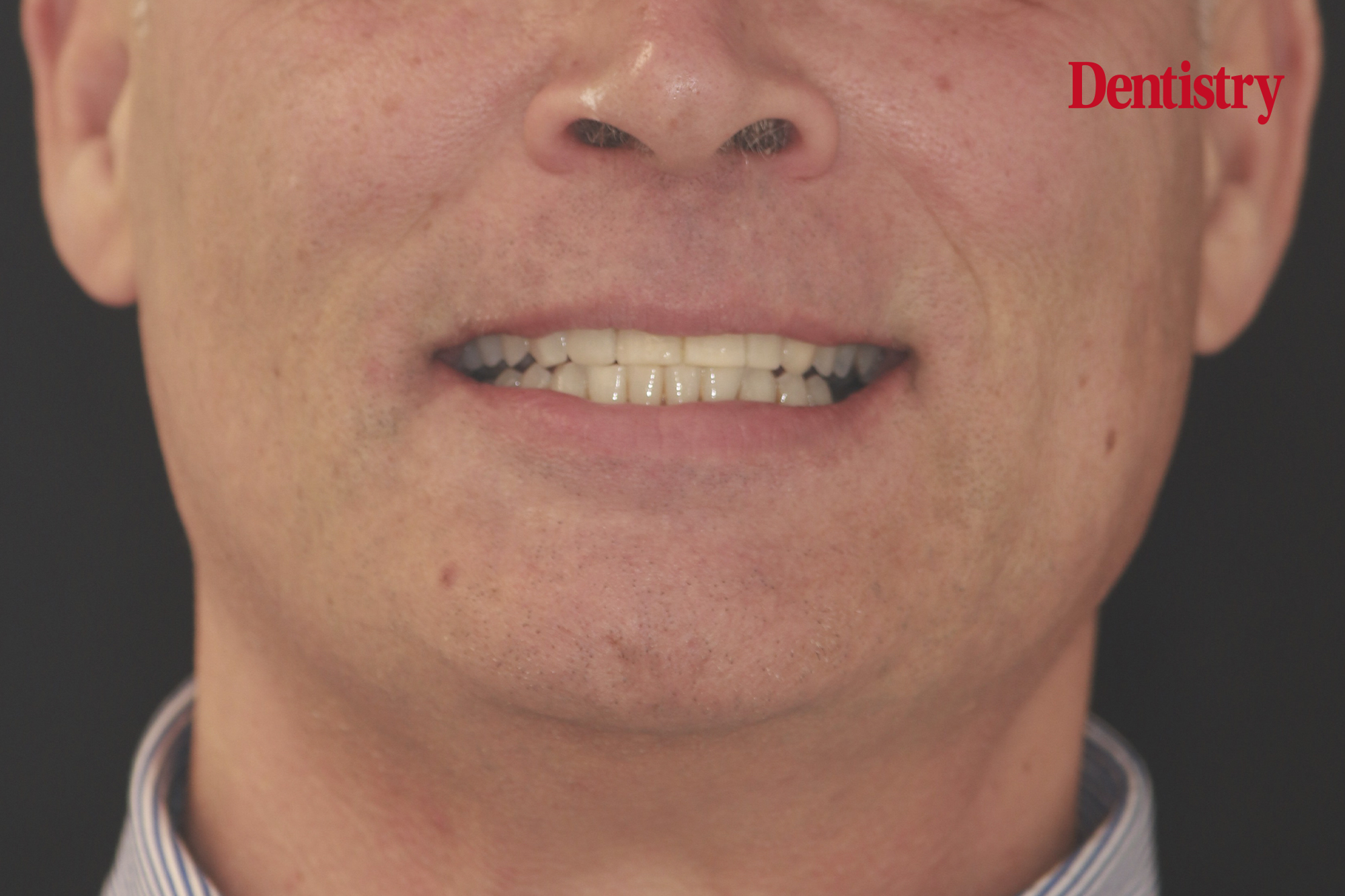 Treating diastema with periodontal disease: a multidisciplinary case