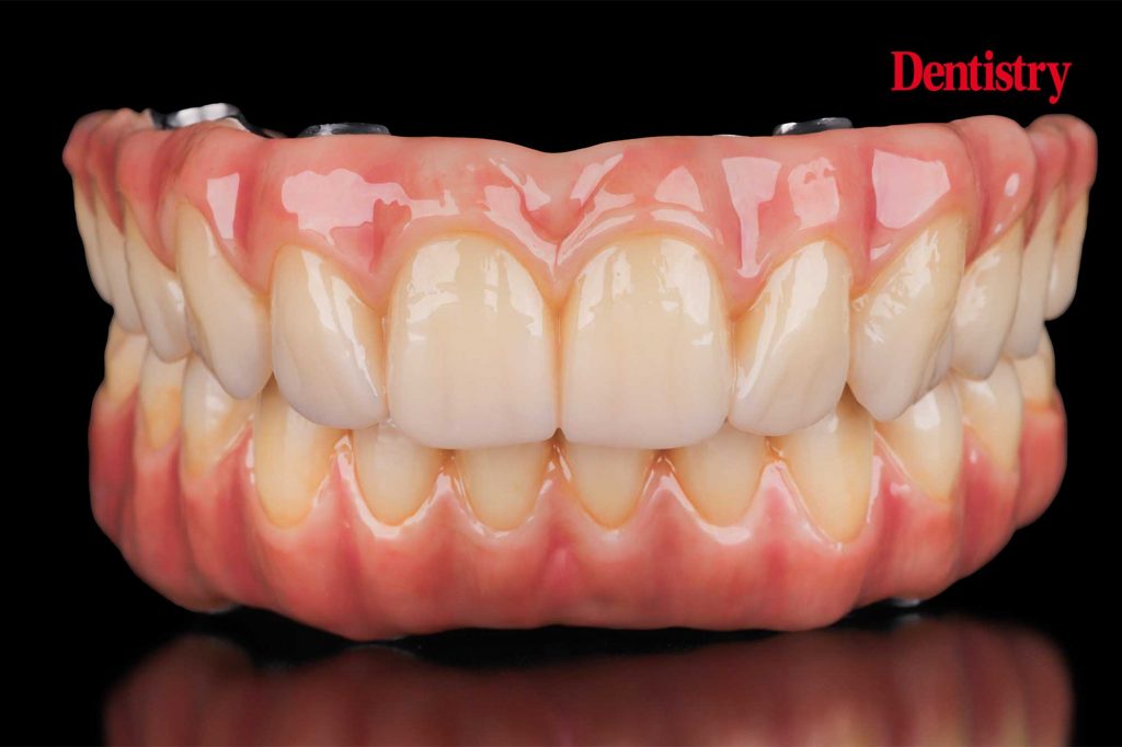 Bar-supported zirconia bridges on implants and Zirkonzahn multi unit abutments
