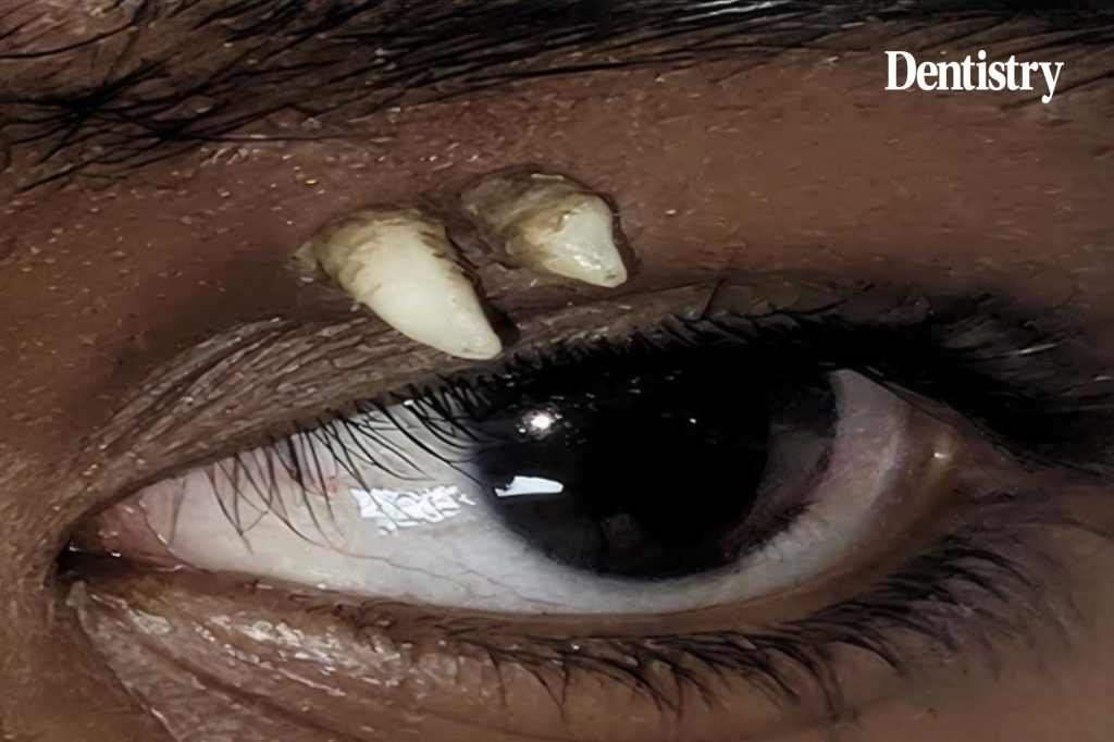 Ectopic tooth found in eye socket thought to be world first