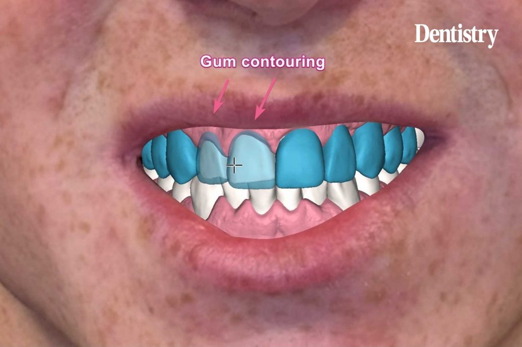 From invasive to additive: rethinking the 3D veneer workflow