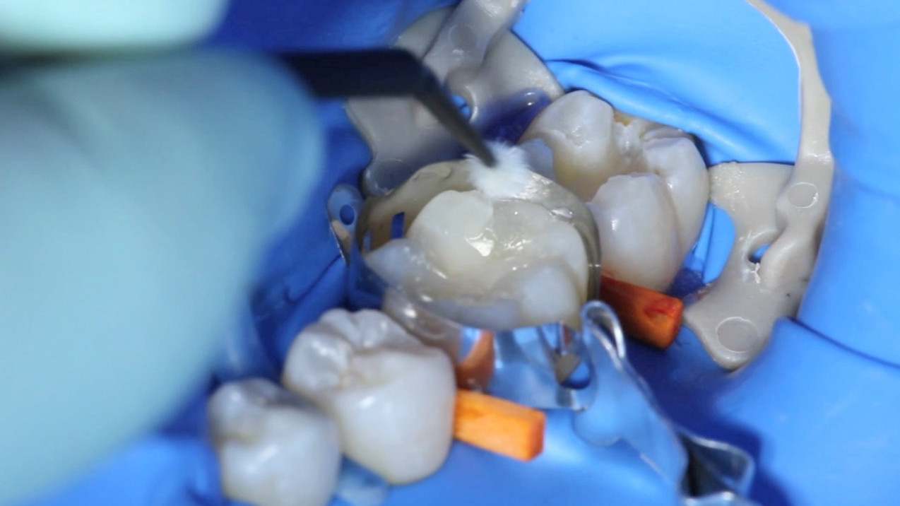 Direct composite restorations Dentistry.co.uk