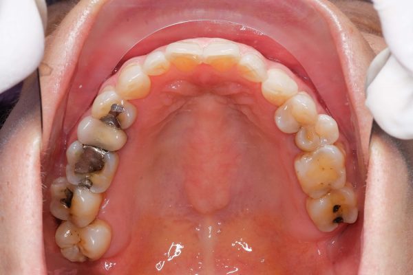 dental amalgam