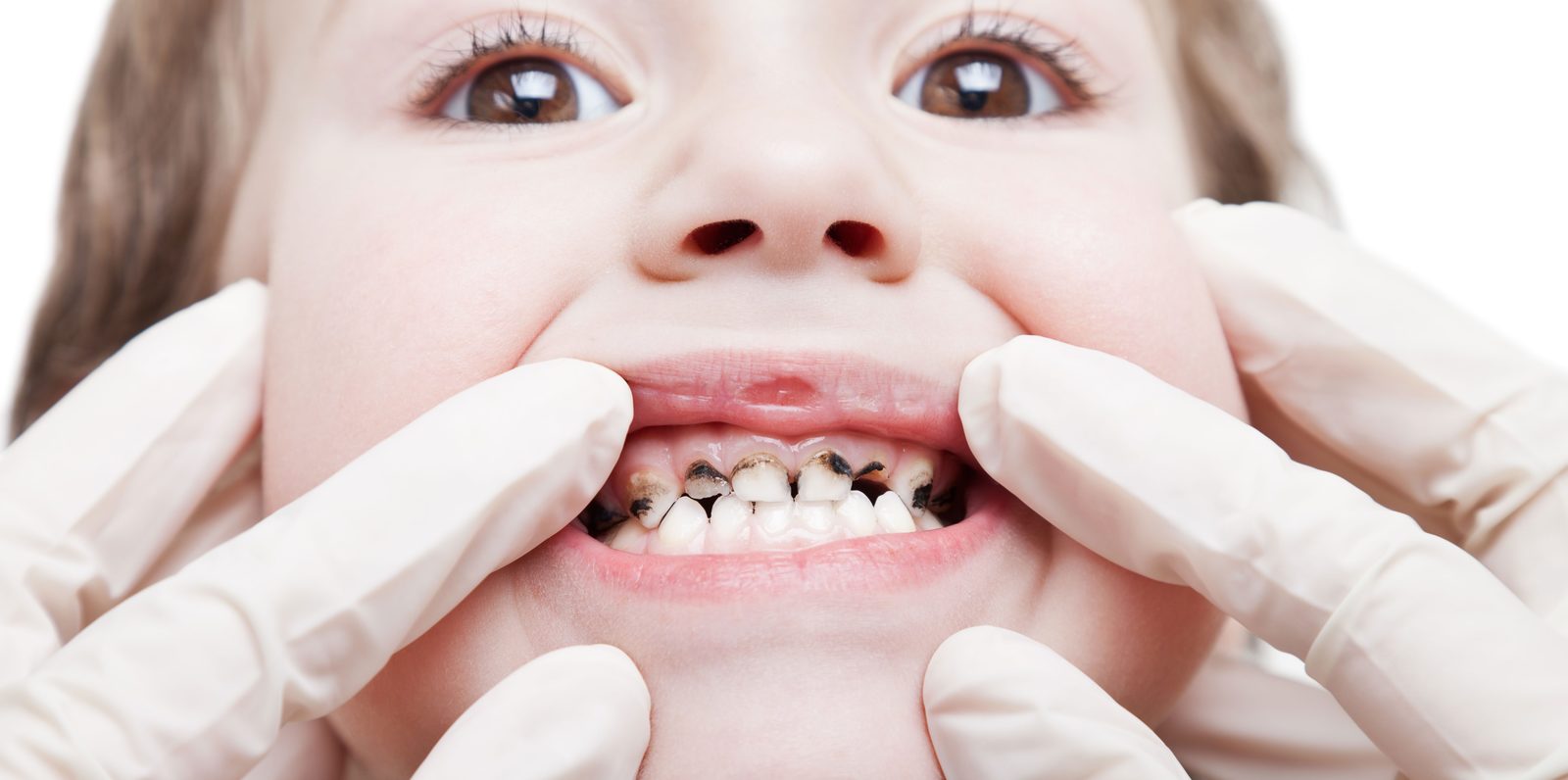 tackling-poor-oral-health-in-children-dentistry-co-uk