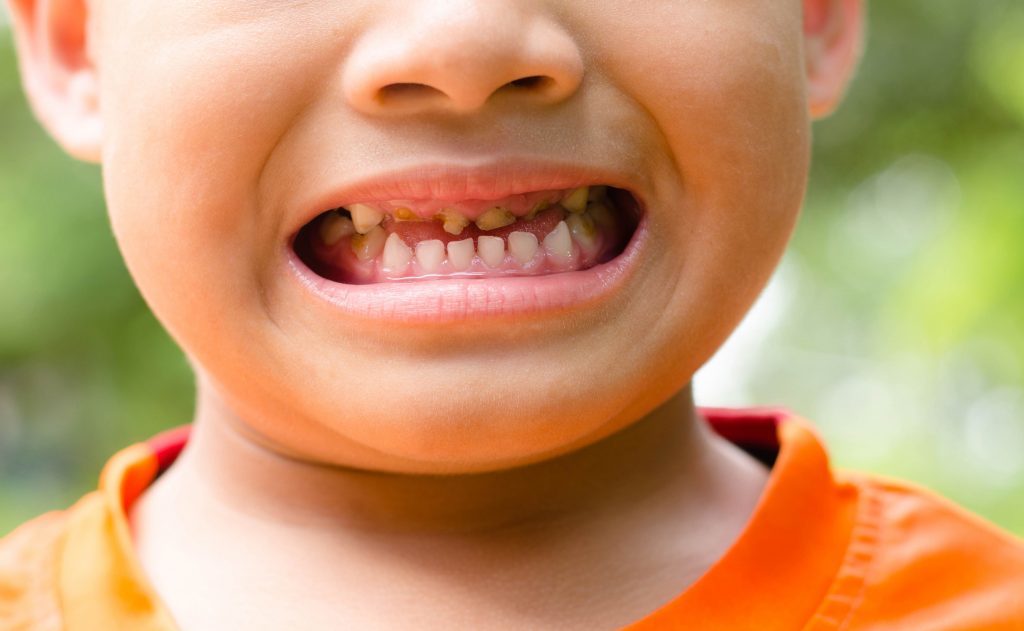 Delays for Scottish children with extensive tooth decay - Dentistry.co.uk