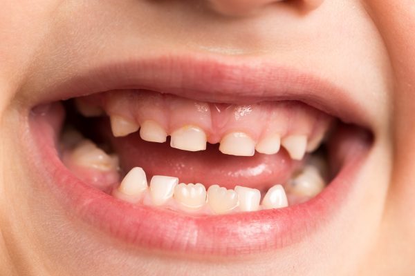 Welsh government launches 'Baby teeth do matter' campaign - Dentistry.co.uk