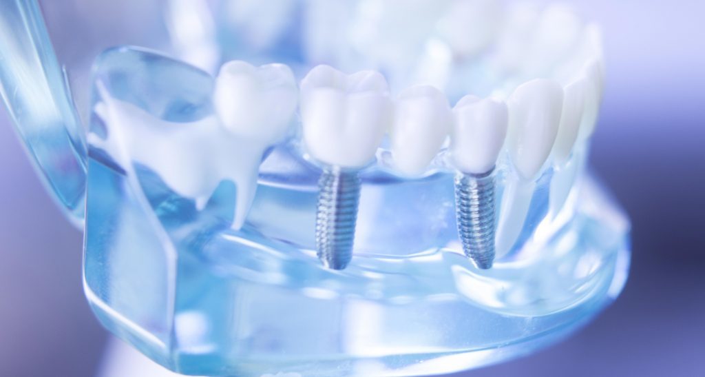 Standards for implant dentistry get an update - Dentistry.co.uk