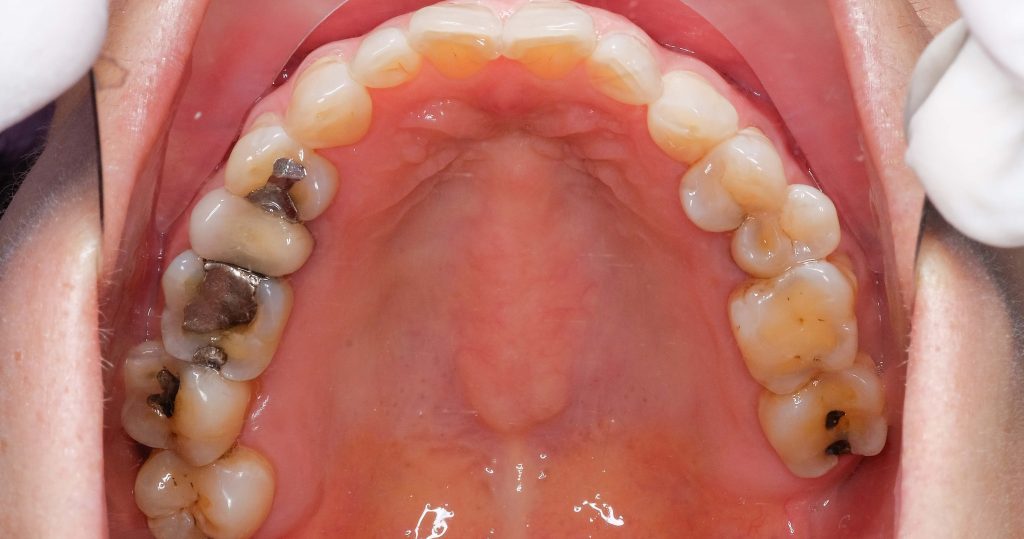 Amalgam phase down needs investment - Dentistry.co.uk