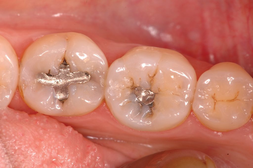 Durable restorative material for class I and II cavities - Dentistry.co.uk