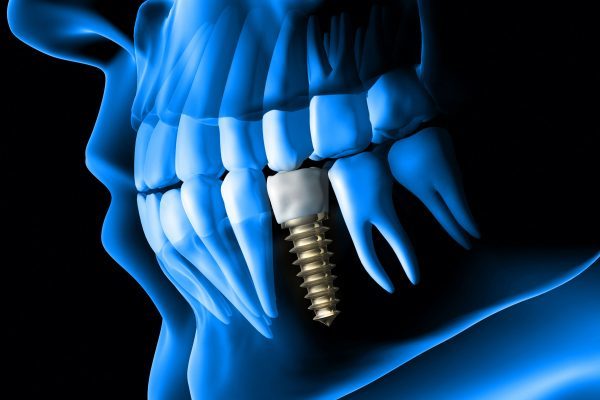 Complications Of Implant Dentistry - Dentistry.co.uk