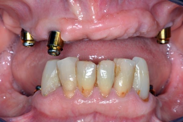 Instructions for use: CM Loc Flex implants - Dentistry.co.uk