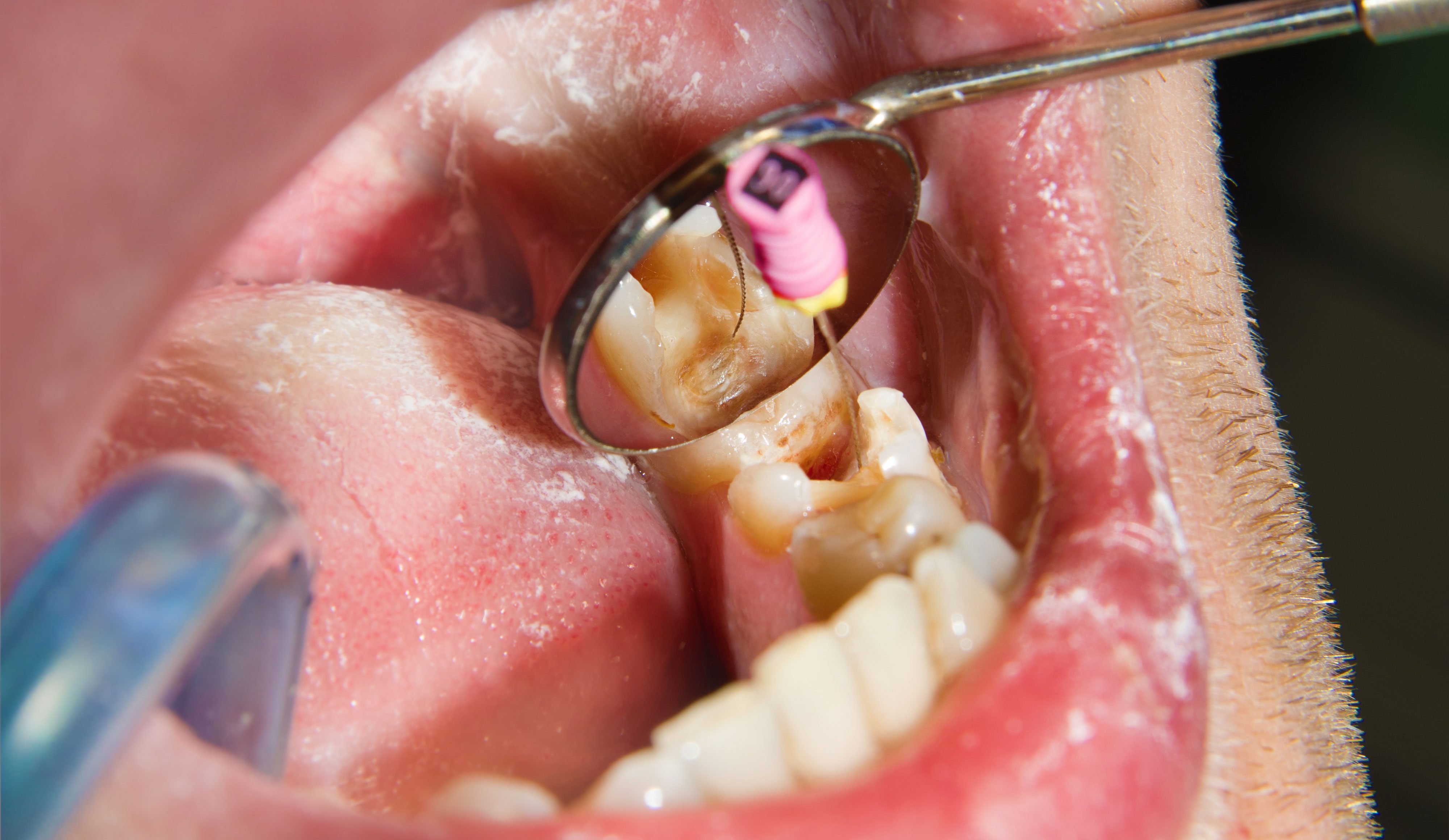 root-canal-treatment-fear-of-litigation-dentistry-co-uk