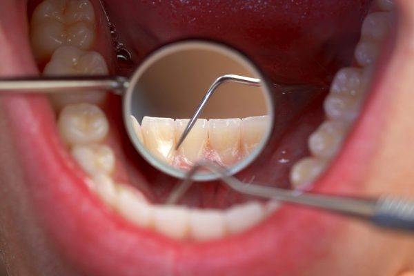 erosive tooth wear third most common oral health disease