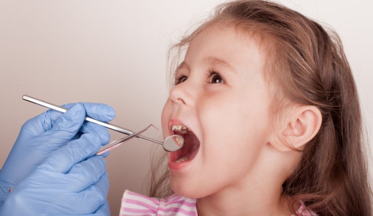 Fillings not the best way to tackle tooth decay in children - Dentistry