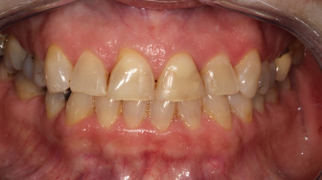 teeth translucent cracking