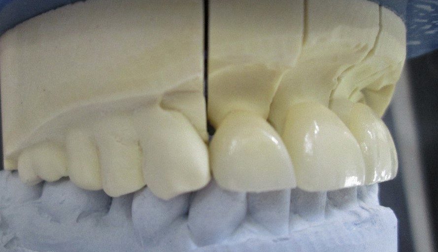 translucent tooth