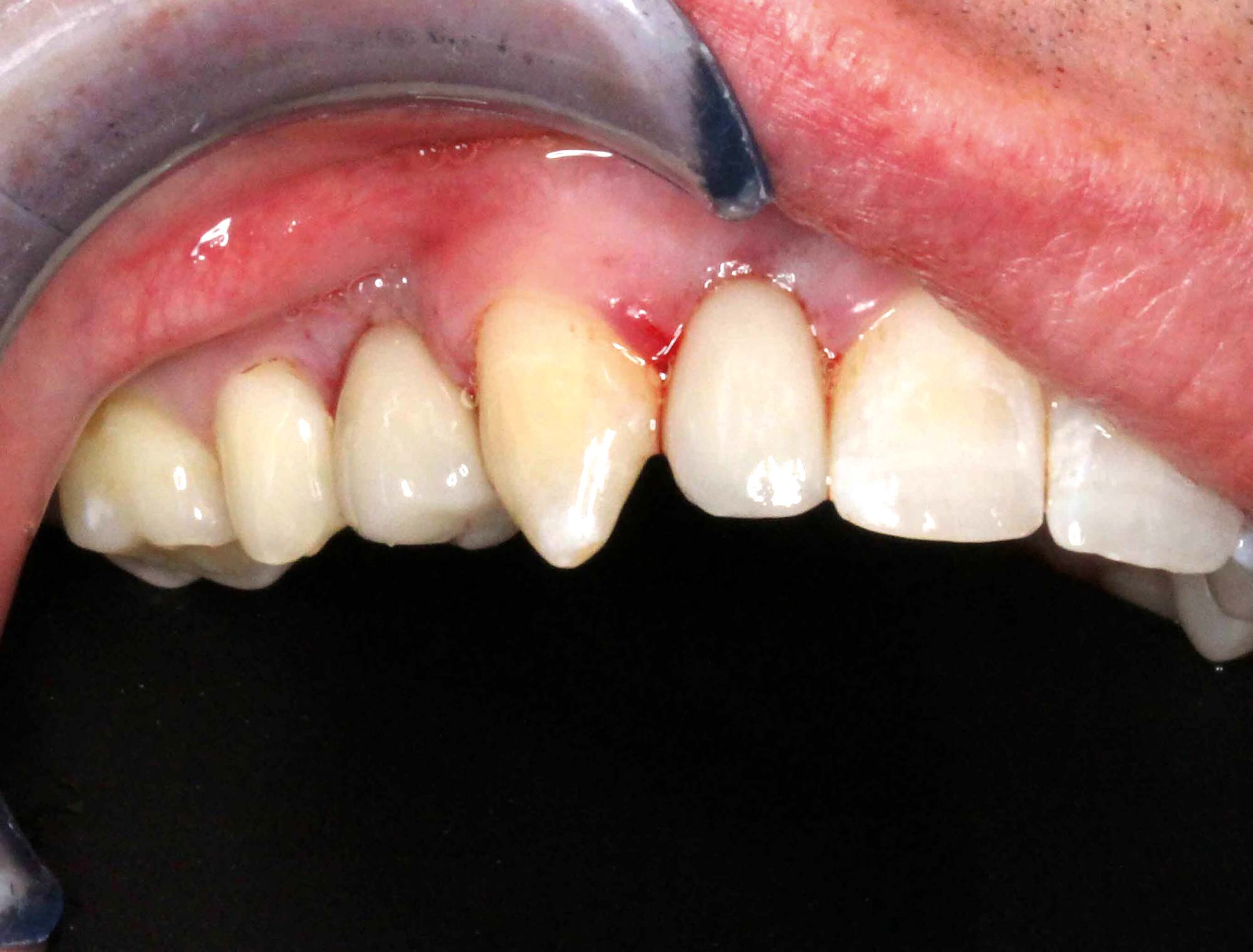 https://dentistry.co.uk/wp-content/uploads/2020/01/Figure-9-implant-placement.jpg