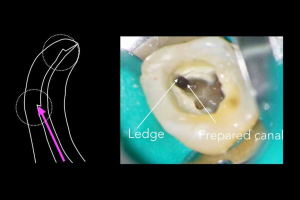 Root canal treatment Figure 1: Ledges can occur at the point of primary curvature and apically