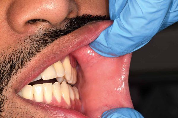 How dentists can screen for mouth cancer – Dentistry.co.uk