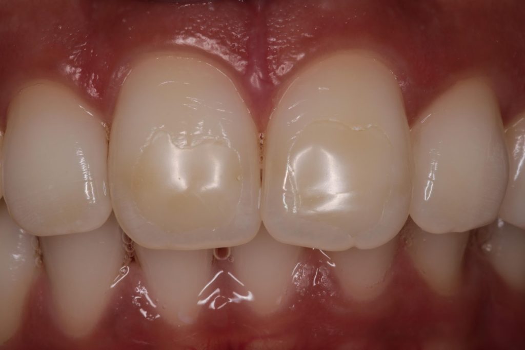Disguising yellow spots and replacing composite bonding Dentistry.co.uk