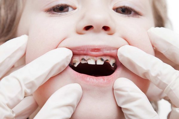 One in four five year olds experience tooth decay, according to new PHE data