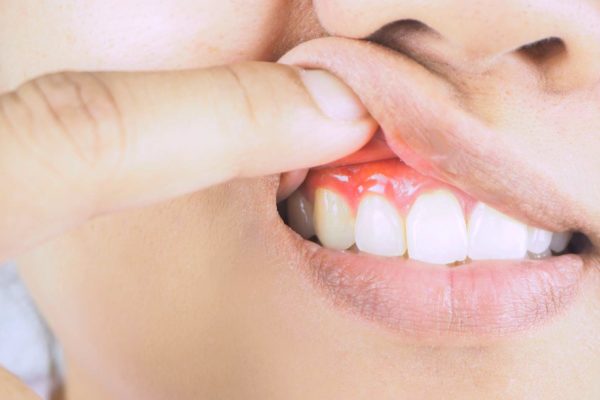 People who suffer from gum disease have a higher risk of developing certain forms of cancer, a study suggests