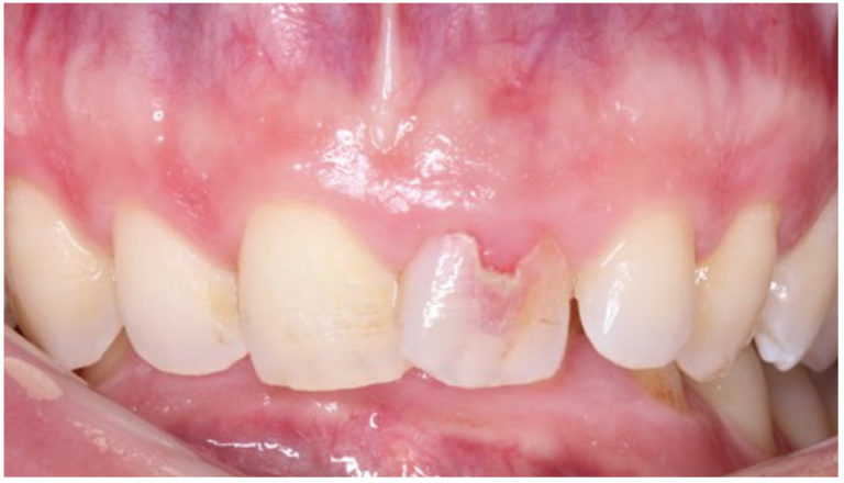 The root of the problem – external cervical resorption – Dentistry Online