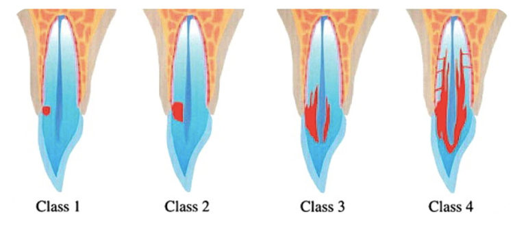 The root of the problem – external cervical resorption – Dentistry Online