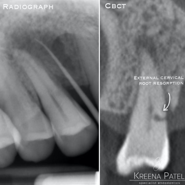 The root of the problem external cervical resorption Dentistry Online