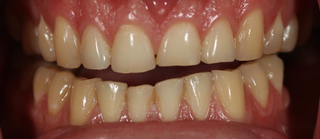 Prosthodontips – diagnosing and treating toothwear – Dentistry Online