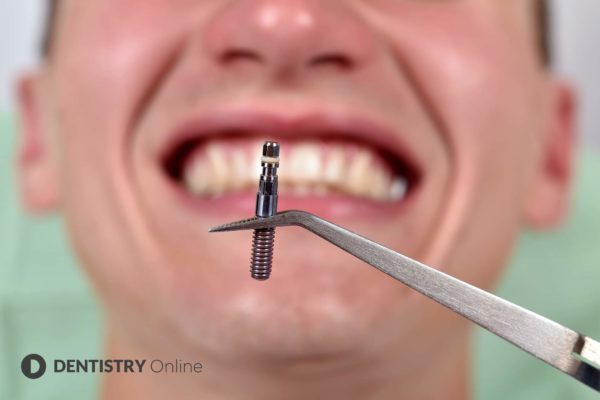 Changing the side of the mouth that you chew on can damage a dental implant, it has been revealed