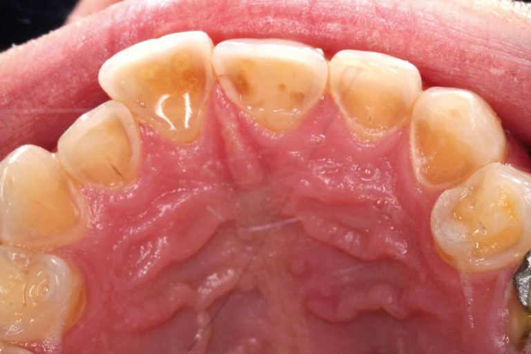 The Importance Of Screening For Erosive Tooth Wear – Dentistry Online