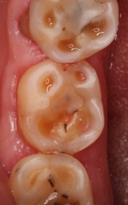 Figure 1 tooth wear