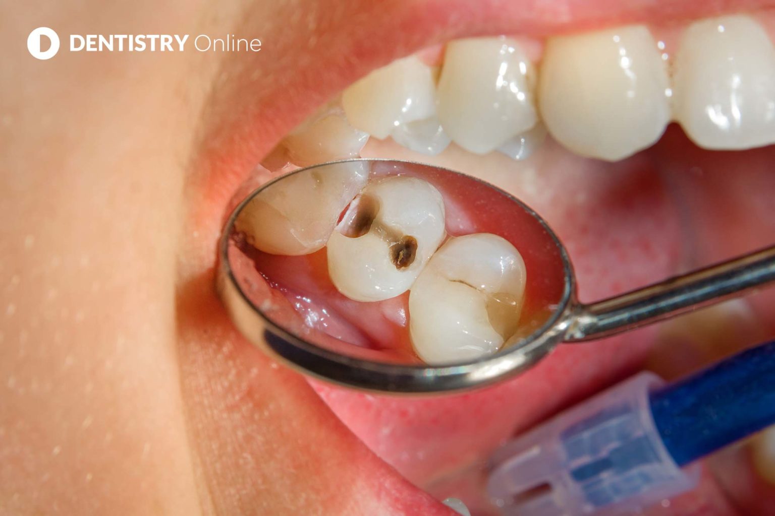 eight-in-10-at-increased-risk-of-caries-research-shows-dentistry-online