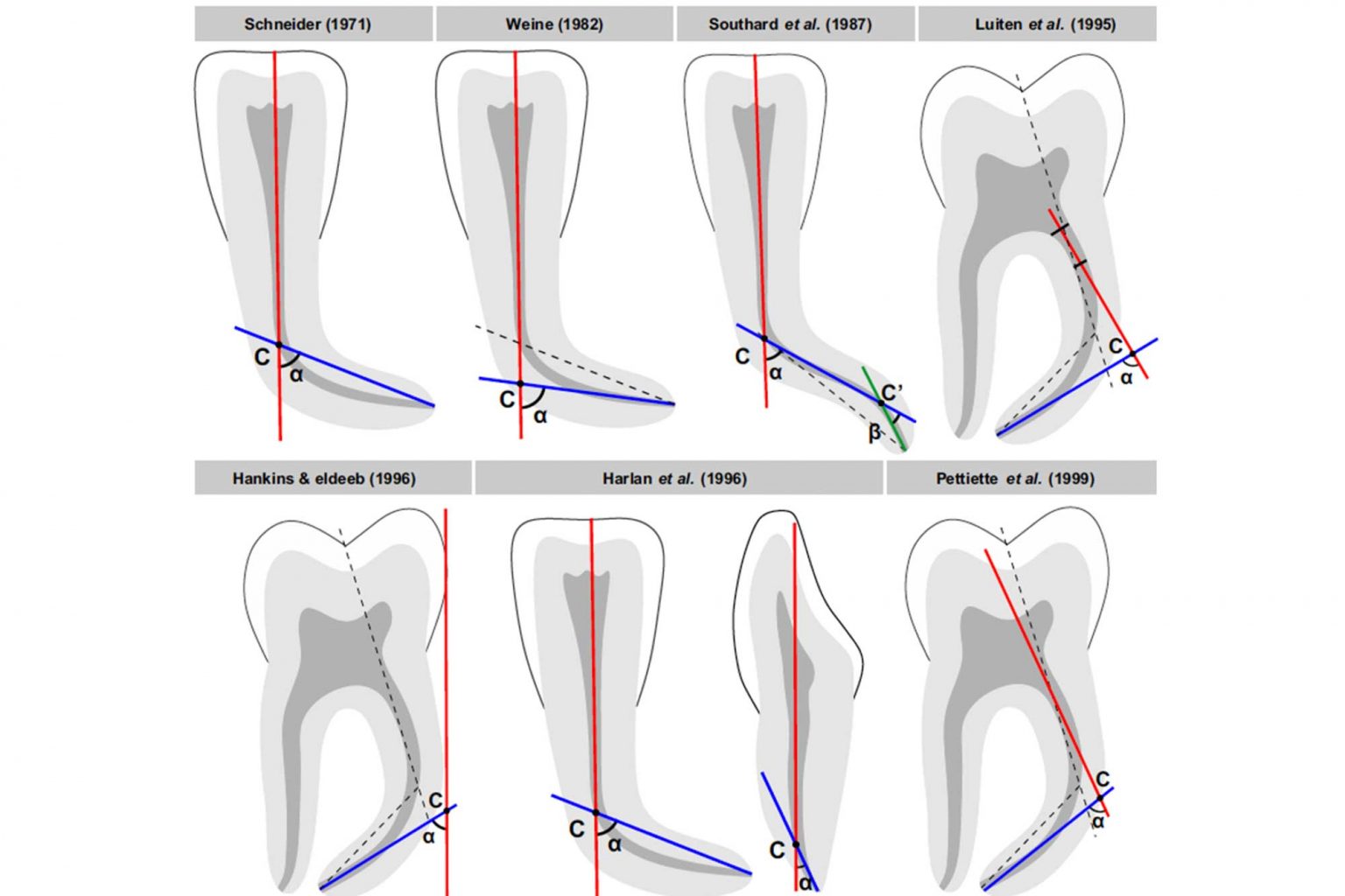 The endo expert managing curved canals Dentistry Online