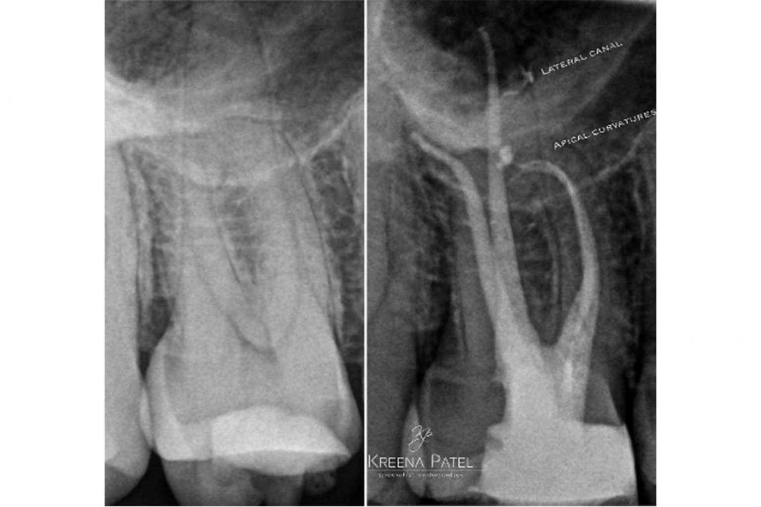 The endo expert managing curved canals Dentistry Online