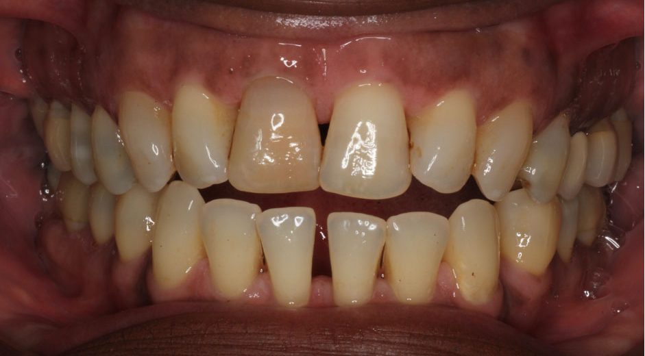 Prosthodontips – canine guidance or group function? - Dentistry.co.uk