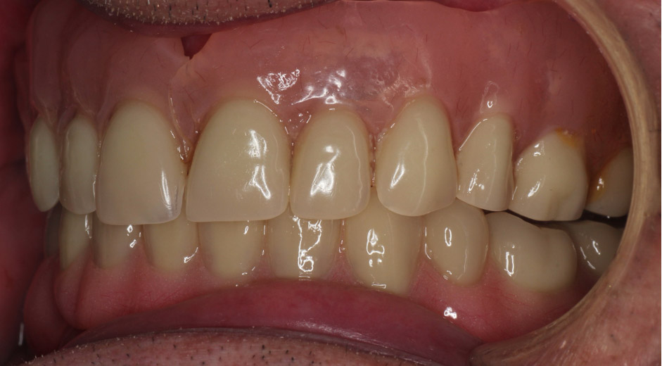 prosthodontips-canine-guidance-or-group-function-dentistry-co-uk