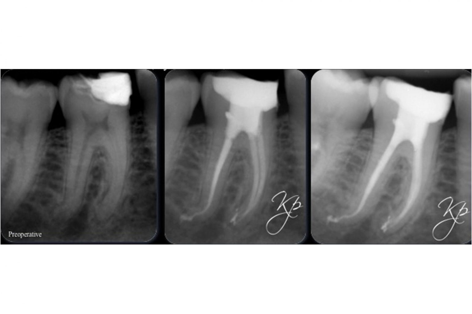 The endo expert managing curved canals Dentistry Online