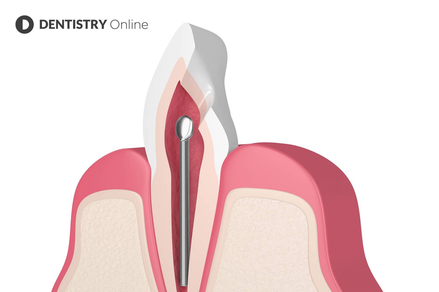 The history of metal posts and where we are now Dentistry online