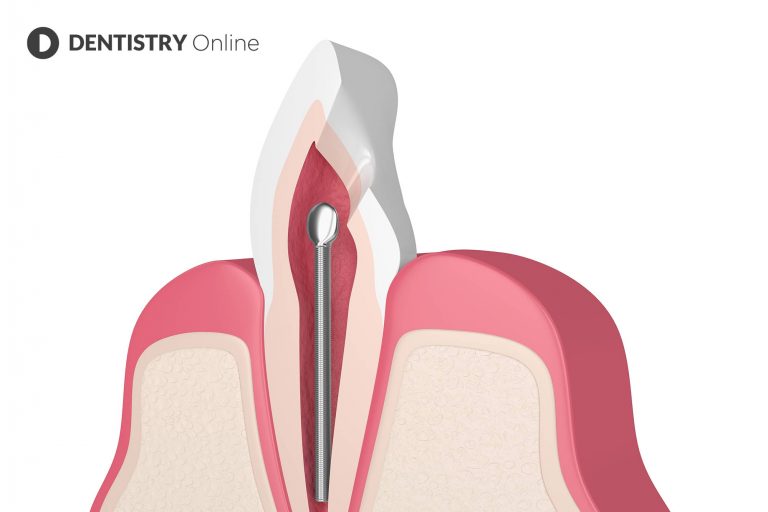 The history of metal posts and where we are now Dentistry online