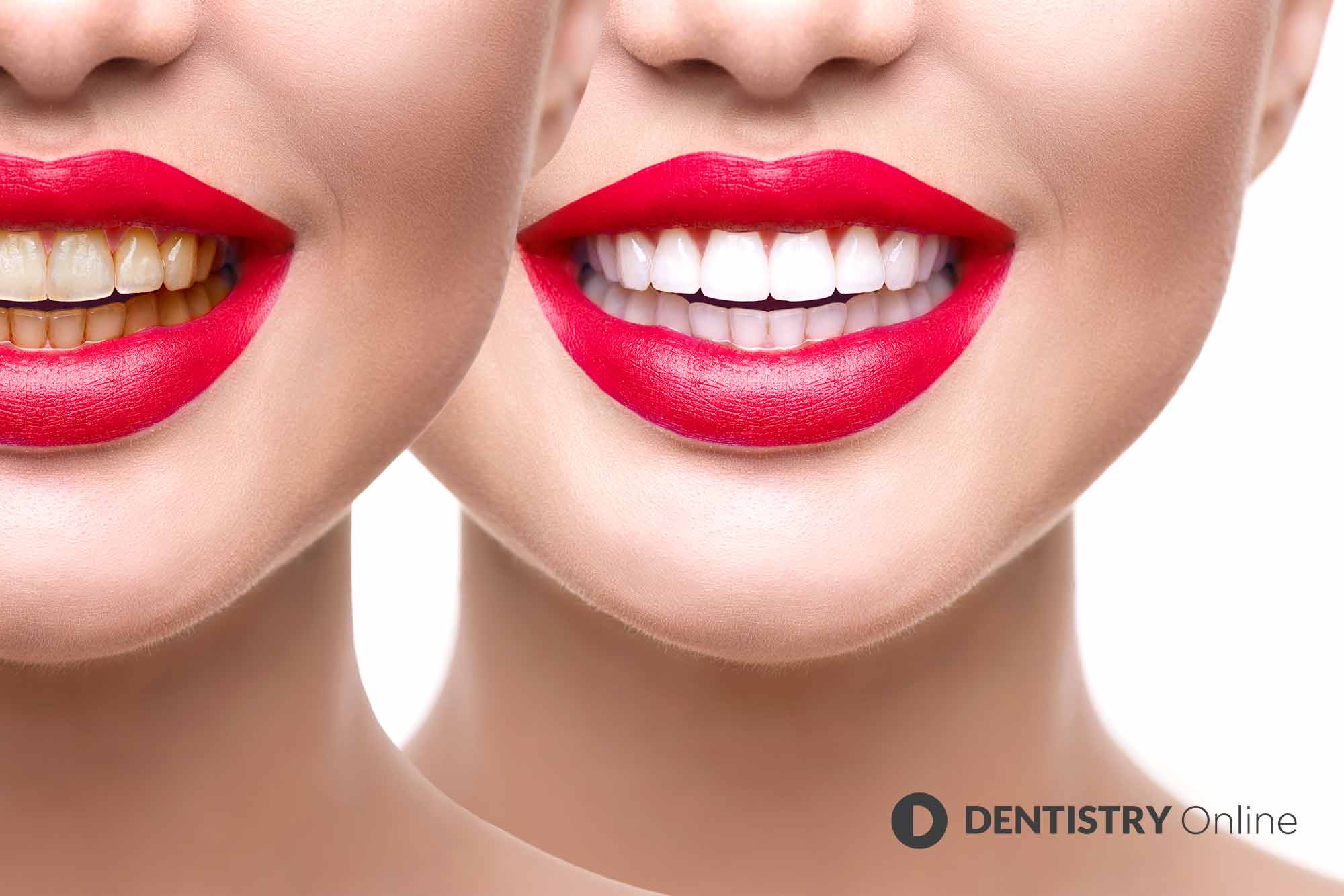 Bitten by the whitening bug. The general public is still worryingly unaware of the legal requirement for tooth whitening to be performed only by dental professionals