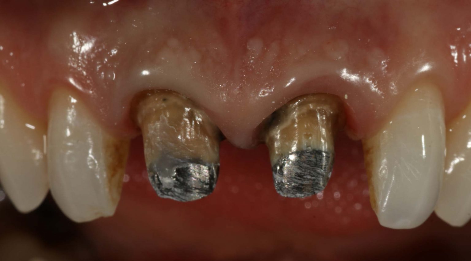 Prosthodontips temporary crowns not so temporary? Dentistry Online