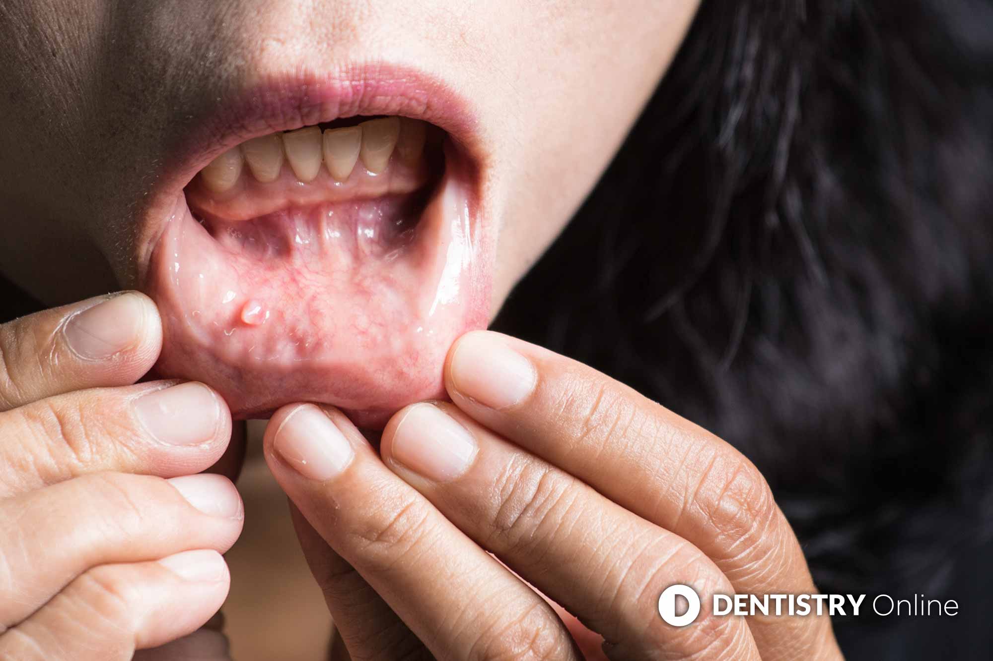 A leading consultant has seen an increase in signs of mouth cancer due to early signs being missed due to the pandemic