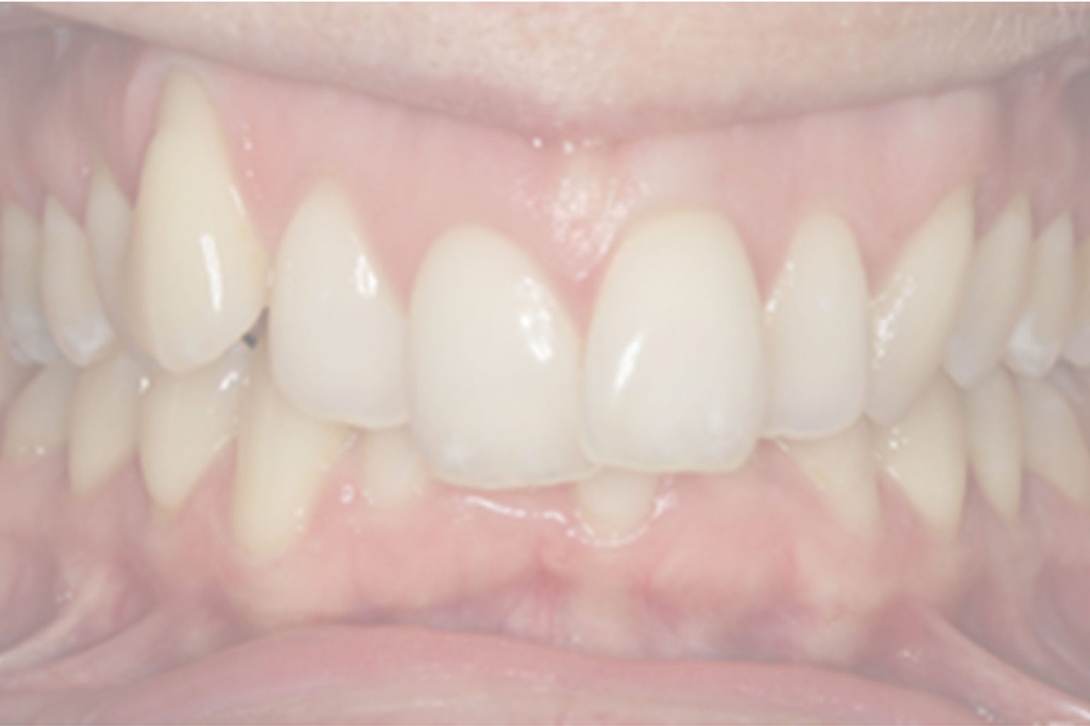Invisalign case study part one the deep bite Dentistry Online