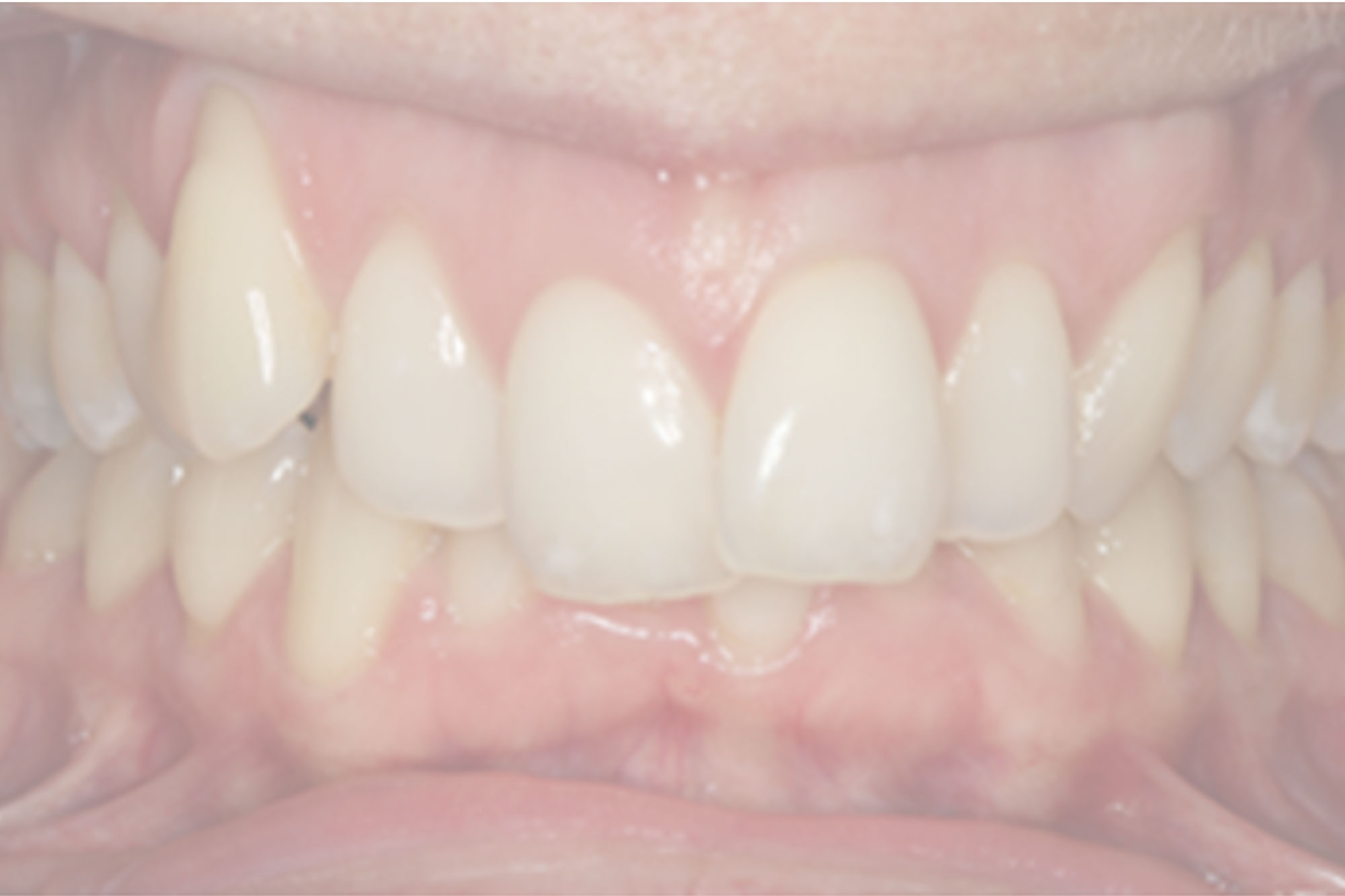 Family Braces - 😢 Problem: Significant Overbite, Deep Bite, Bad Bite at  the Back, and Upper/Lower Crowding 👩🏻‍⚕️ Solution: Bite Corrector +  Invisalign 📆 Treatment Length: 17 months 😁 Results: an Outstanding