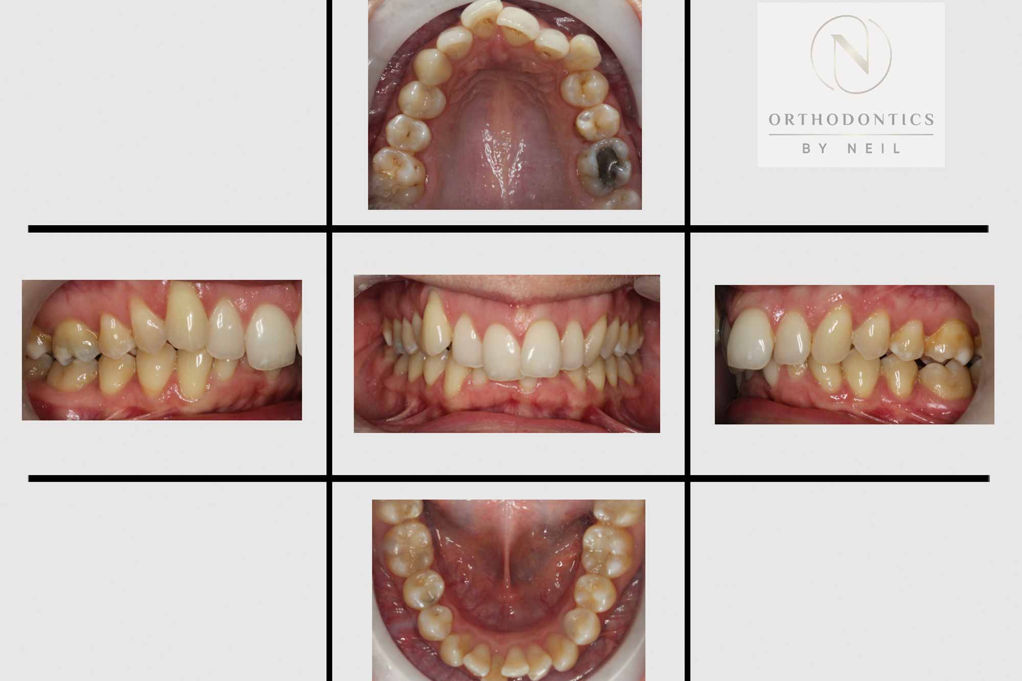 Invisalign Before and After Case Study 9