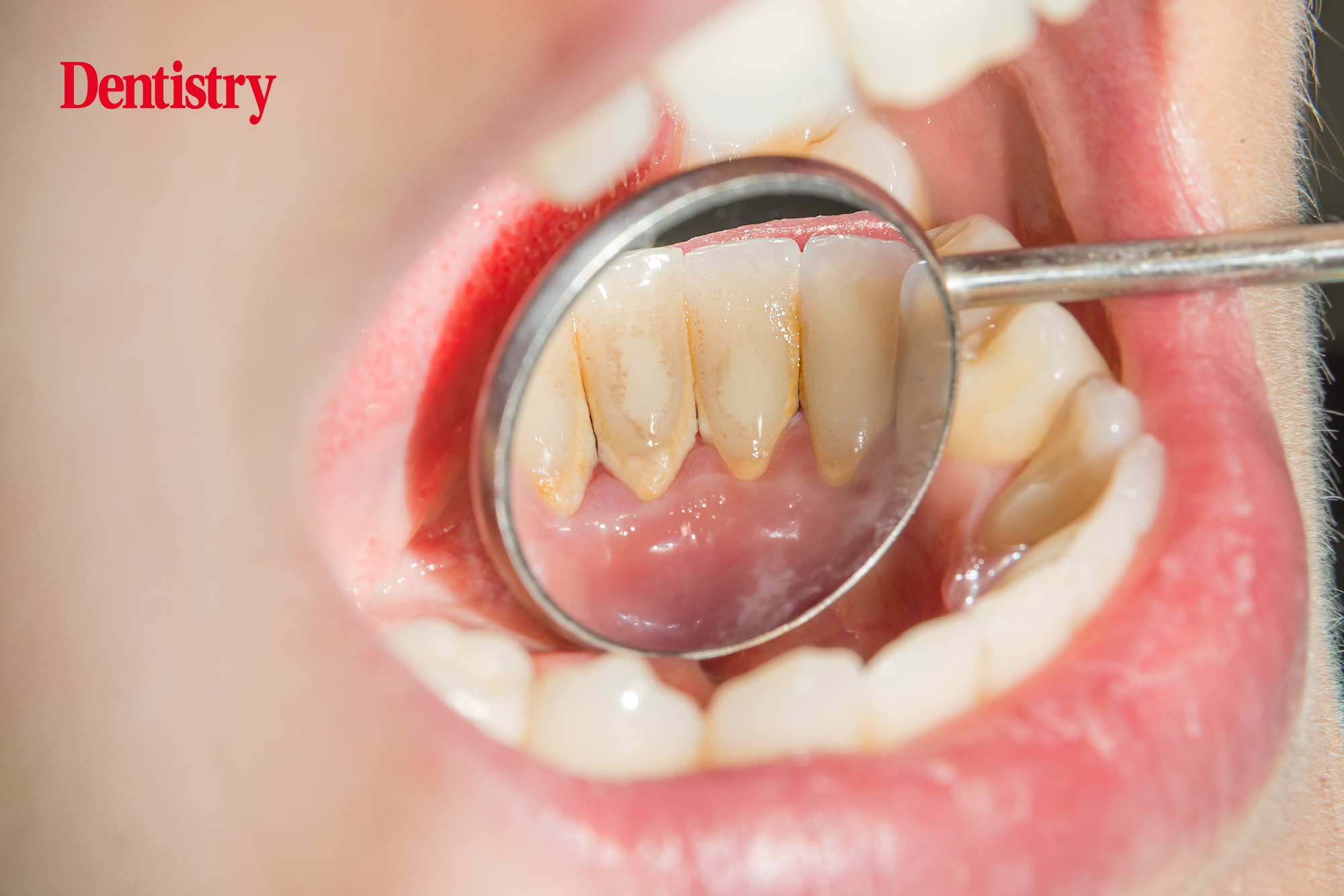 Individuals suffering from an accumulation of dental plaque are at increased risk of COVID-19 reaching the lungs