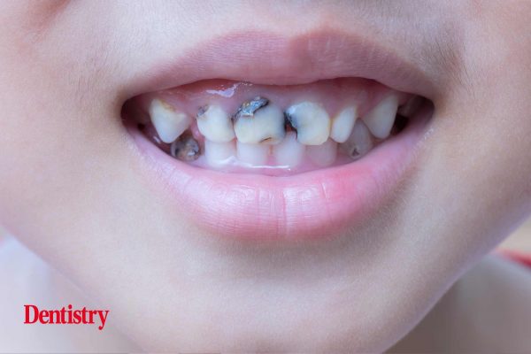 More than 10% of England's three year olds are suffering from decayed teeth, a new report reveals
