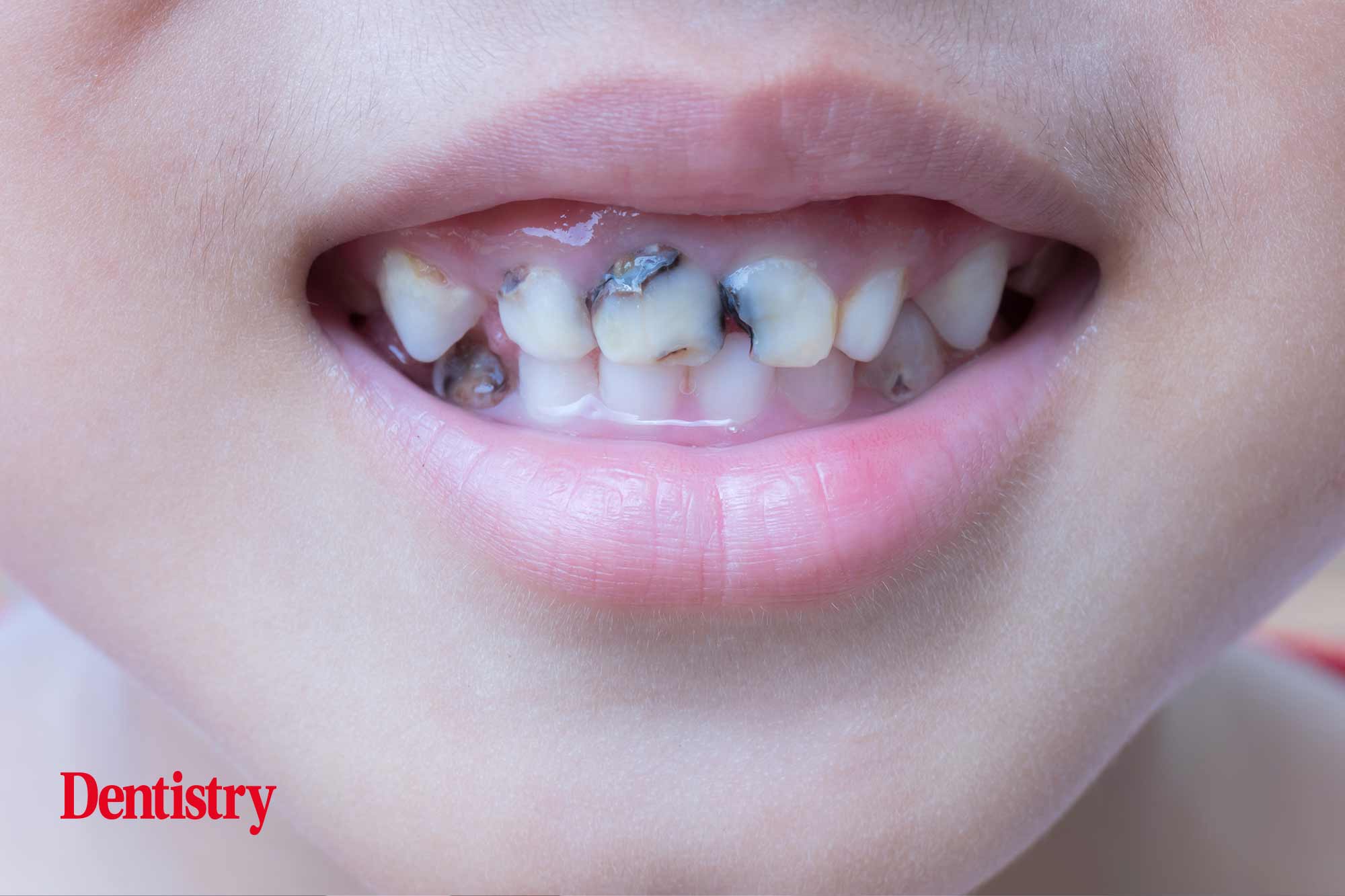 One in 10 three year olds already suffer from tooth decay