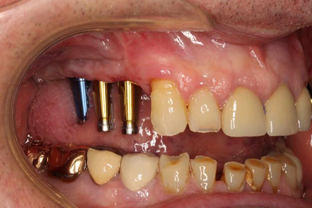 Implant insights the implant impression Dentistry